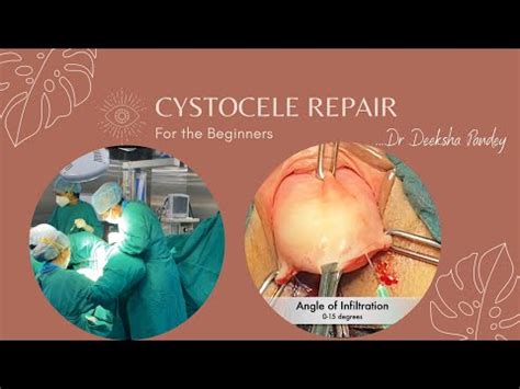 In this current video I will go ahead and add the levatorplasty method I use for Rectocele Repairs. . Cystocele and rectocele repair surgery video